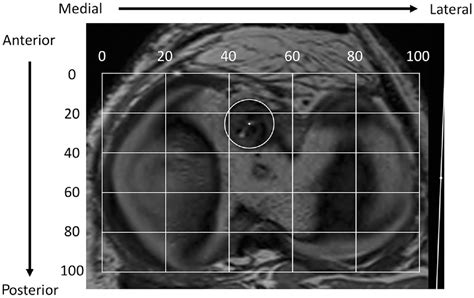 Graft Size And Orientation Within The Femoral Notch Affect Graft