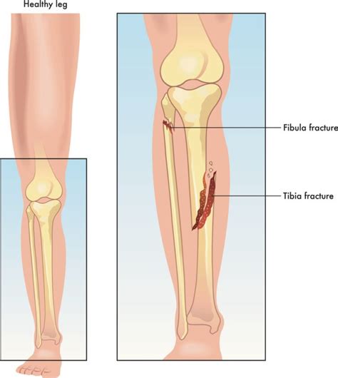 Tibia Fractures - Types, Symptoms, Causes & Treatment - Zealmax Innovations Pvt Ltd