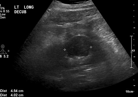 Body Imaging - Kidney - International Contrast Ultrasound Society