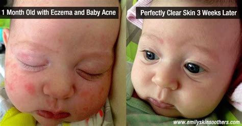 How To Tell The Difference Between Baby Eczema And Acne Baby Viewer