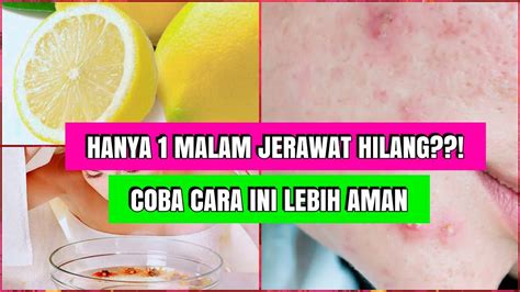 Cara Menghilangkan Jerawat Secara Alami Youtube