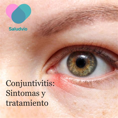 Qué Es La Conjuntivitis Y Como Se Puede Tratar Saludvio