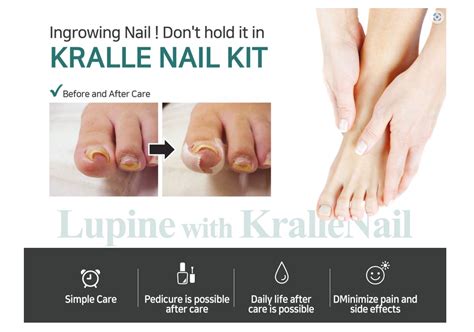 Dr Kralle Ingrown Toenail Curved Toenail Corrector Salong Care Stainless Steel Toenail Tool And