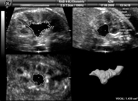 Fetal Hydronephrosis Ultrasound