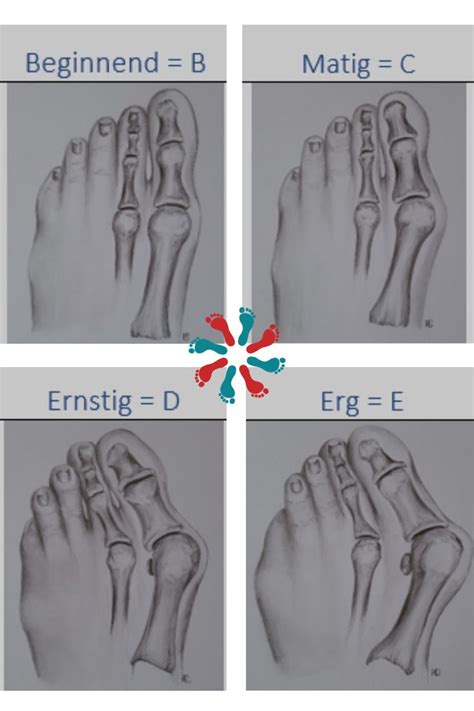 Voor De Scheve Grote Teen De Hallux Valgus Zijn Verschillende