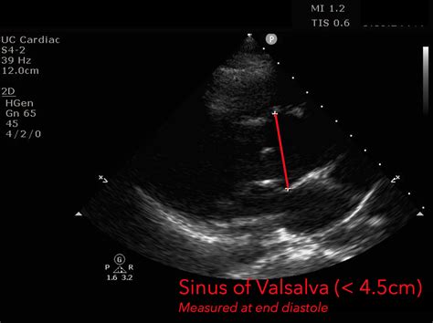 Aortic Dissection Ultrasound