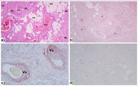 Histolog A Del Tumor A Tinci N Con Hematoxilina Eosina X Ad