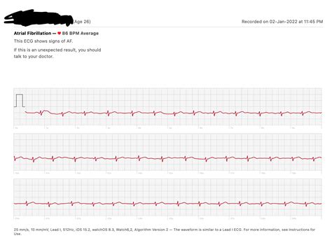 29 and just got AFib : AFIB