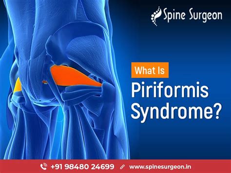 Piriformis Syndrome Causes