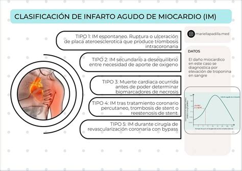 Clasificación De Infarto Agudo De Miocardio Mariella Padilla Udocz