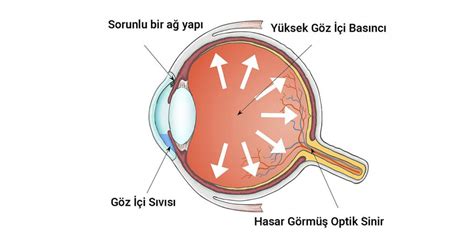 Göz Tansiyonu arşivleri Doç Dr Fatih Çakır Gündoğan