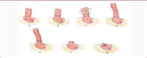 Figure 1 From Altemeiers Procedure For Loop Colostomy Prolapse In