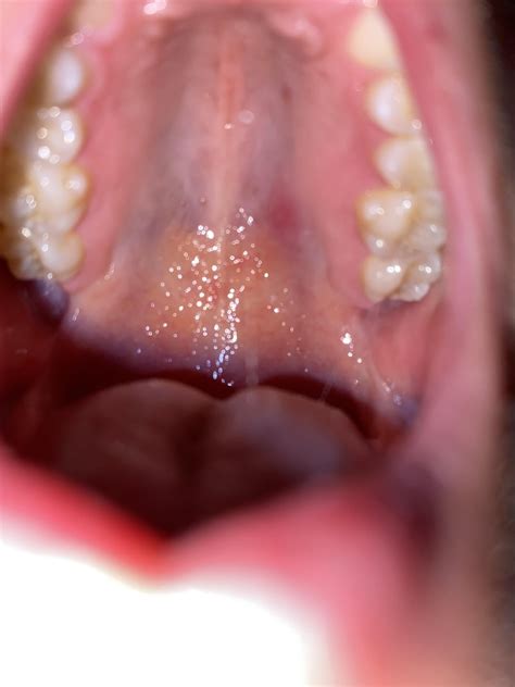 Red Sore Patch On Roof Of Mouth R Askdentists