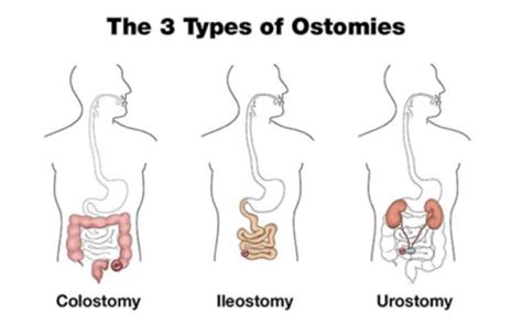 Stoma Flashcards | Quizlet