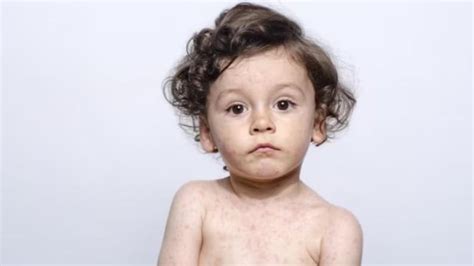 What You Need To Know About Measles In Saskatchewan Cbc News