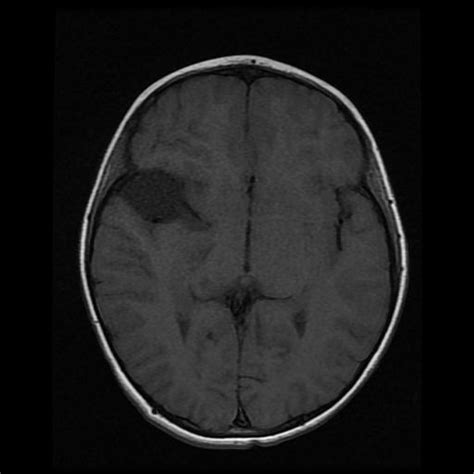 Arachnoid Cyst Middle Cranial Fossa Image