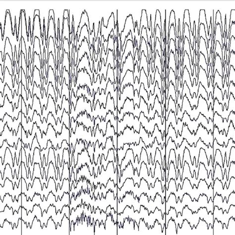 Eeg Recordings Of Case 2 A Generalized 4 To 7 Hz Spike And Wave