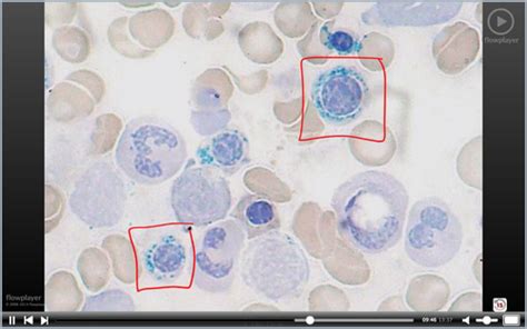 Microcytic Anaemia Flashcards Quizlet