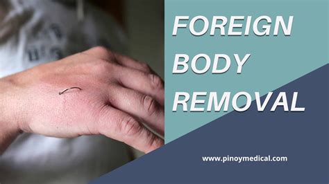 Foreign Body Removal Price in the Philippines 2025 — PinoyMedical