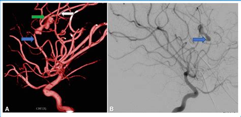 Figure 2 From Successful Endovascular Management Of An Unruptured