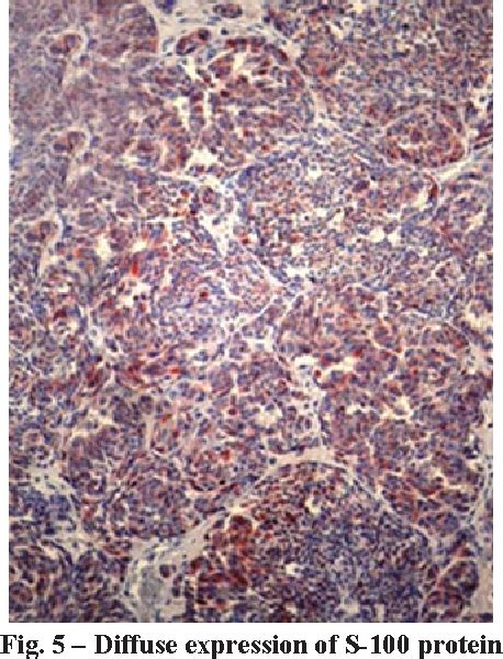 Figure From Metastatic Malignant Ovarian Melanoma A Case Report