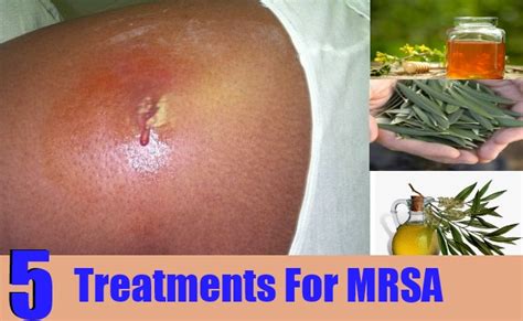 5 Effective Treatments For MRSA – Natural Home Remedies & Supplements