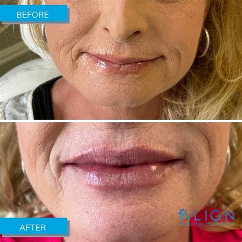 Before After Results Align Injectable Aesthetics