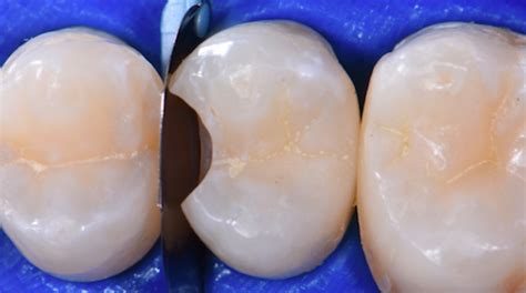 Minimally Invasive Class Ii Restoration Of An Upper Premolar A