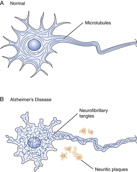 Alzheimer’s disease | Nurse Key