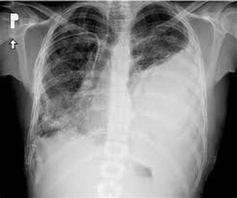 Causes Of Massive Hemothorax Medizzy