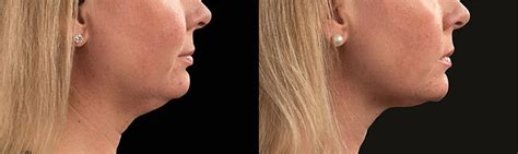 Chin CoolSculpting | Before and After - Cost - Reviews