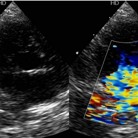 El Doppler Continuo Registra La Velocidad De Flujo Sangu Neo En