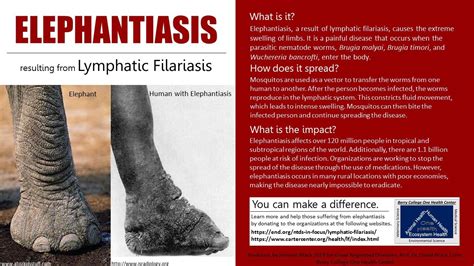 The Horrors Of Elephantiasis Lymphatic Filariasis Disease Lymphatic