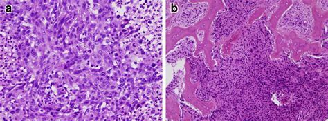 Proximal Type Epithelioid Sarcoma Case Report Of An Unusual