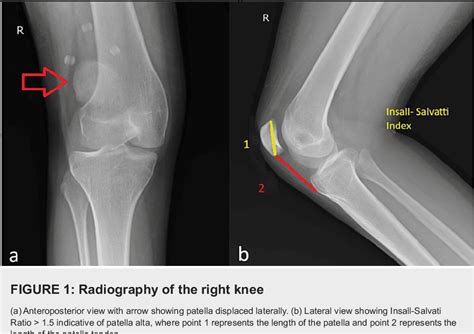 Figure 1 From Revamping Stability Tibial Tuberosity Transfer And