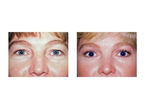 blepharoplasty-eyelid-tuck-dr-barry-eppley-indianapolis - Explore ...