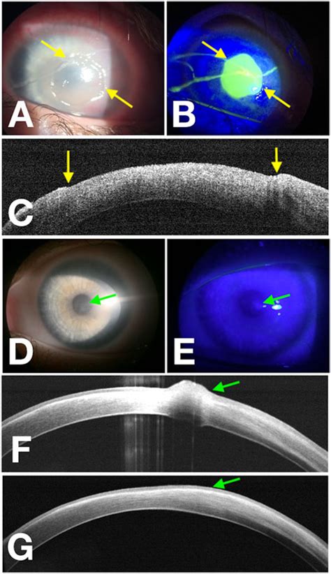 Frontiers Recombinant Human Nerve Growth Factor Cenegermin Driven Corneal Wound Healing