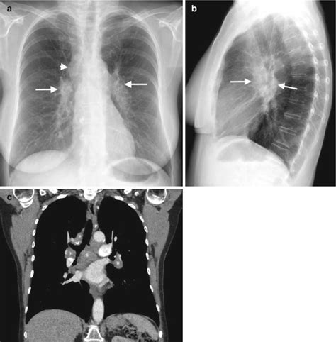 Fig 1 4 [ A C Sarcoidosis Manifesting As Bilateral ] Diseases Of The Chest Breast