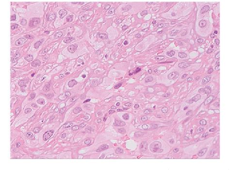 Figure From An Unusual Presentation Of Pneumothorax Associated With