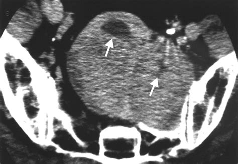 Castleman Disease Contrast Enhanced Pelvic Ct Scan Shows Well Defined