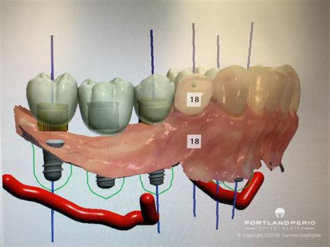 How Digital Technology Is Changing The Dental Implant Process