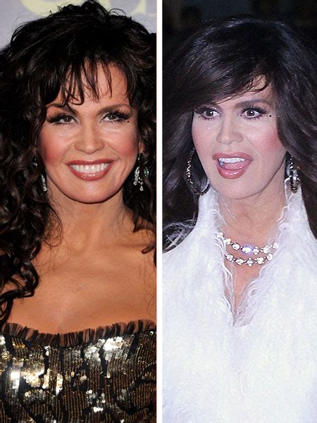 Marie Osmond Plastic Surgery