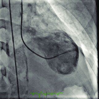 Two Dimensional Echocardiography With Definity Showing LV Thrombus