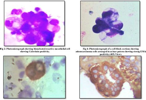 Table 1 From Cytological Evaluation Of Peritoneal Fluid With Special