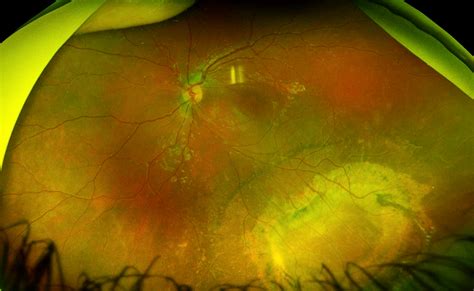 Mystery Diagnosis: X-Linked Retinoschisis — Matt Weed, MD Spokane ...