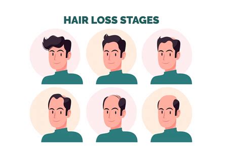 Understanding Hair Loss: The Role of DHT Explained – MyHairSmart