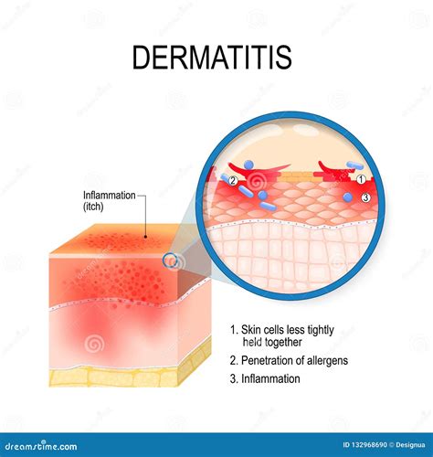 Atopic Dermatitis Images