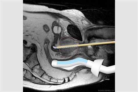 Tulsa Pro Prostate Cancer Treatment