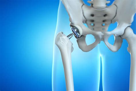 Hip Arthroscopy Vs Total Hip Replacement Procedure and Benefits ...