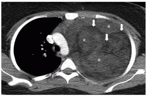 Mediastinum Radiology Key